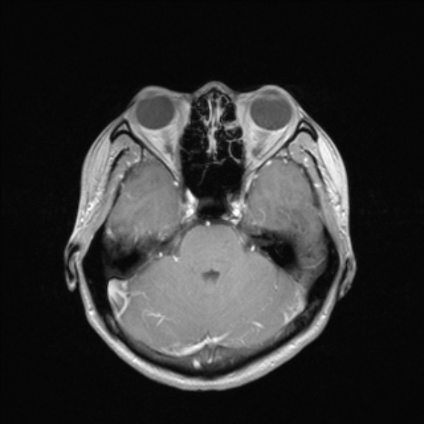 Cerebral abscess (Radiopaedia 24212-24478 Axial T1 C+ 22).jpg
