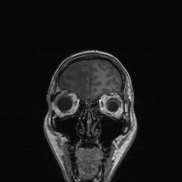 Cerebral abscess (Radiopaedia 24212-24478 Coronal T1 46).jpg