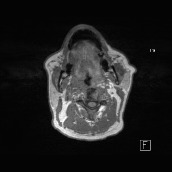 Cerebral abscess (Radiopaedia 26111-26247 Axial T1 3).jpg
