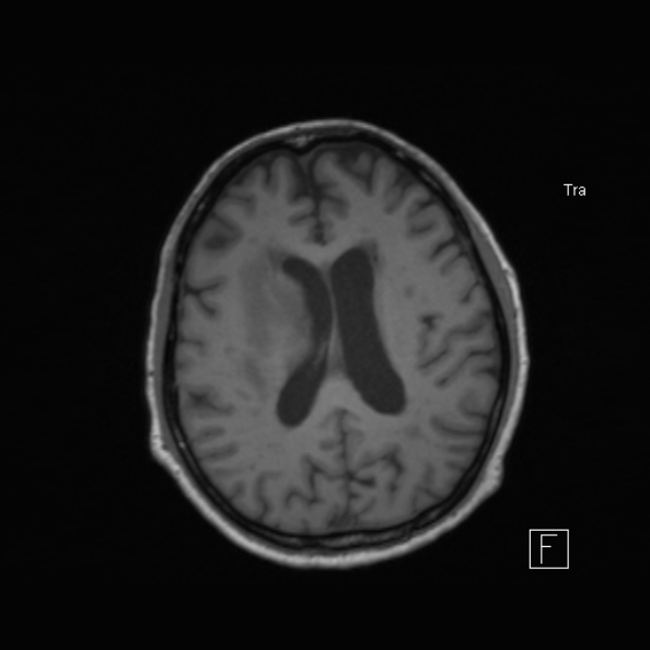 Cerebral abscess (Radiopaedia 26111-26247 Axial T1 38).jpg