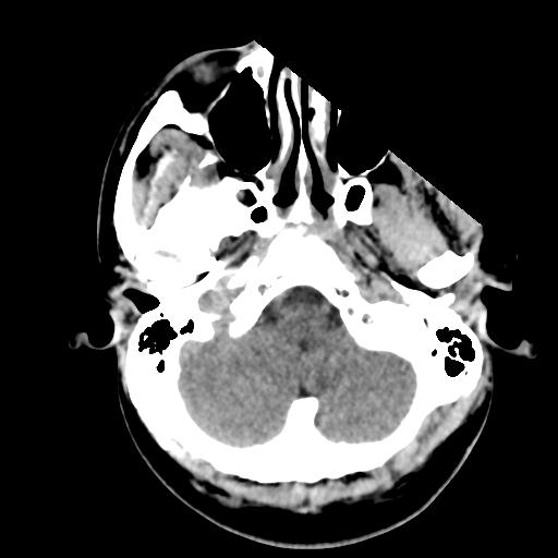 File:Cerebral abscess (Radiopaedia 29451-29919 Axial non-contrast 8).jpg