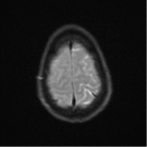 Cerebral abscess (Radiopaedia 60342-68009 Axial DWI 32).png