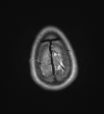 File:Cerebral abscess (Radiopaedia 60342-68009 Axial T2 34).png