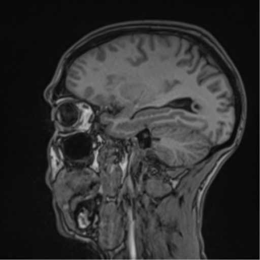 File:Cerebral abscess (Radiopaedia 60342-68009 Sagittal T1 20).png
