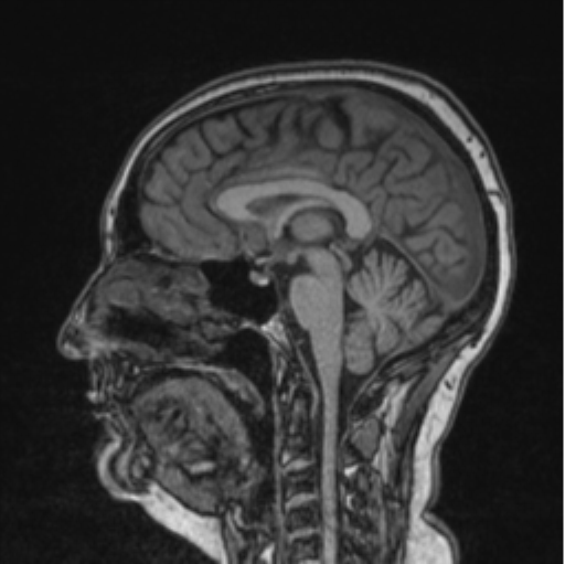 Cerebral abscess from pulmonary arteriovenous malformation (Radiopaedia 86275-102291 Sagittal T1 52).png