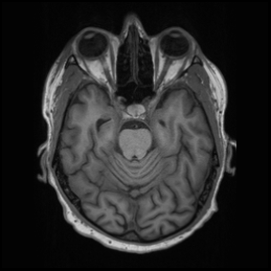 File:Cerebral abscess with ventriculitis (Radiopaedia 78965-91878 Axial T1 17).jpg