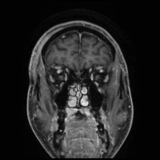 Cerebral abscess with ventriculitis (Radiopaedia 78965-91878 Coronal T1 C+ 15).jpg