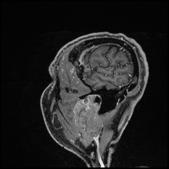 Cerebral abscess with ventriculitis (Radiopaedia 78965-91878 Sagittal T1 C+ 158).jpg