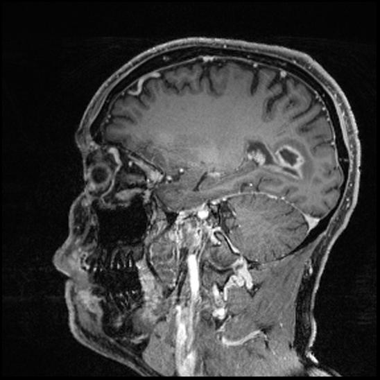 Cerebral abscess with ventriculitis (Radiopaedia 78965-91878 Sagittal T1 C+ 65).jpg