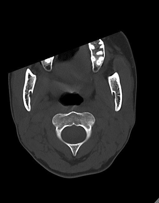 Cerebral abscesses (Radiopaedia 70458-80568 Axial bone window 3).jpg
