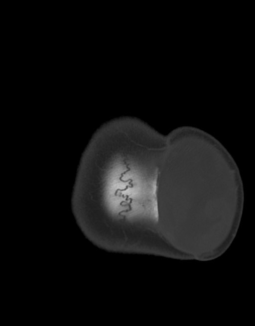 Cerebral abscesses (Radiopaedia 70458-80568 Axial bone window 57).jpg