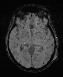 Cerebral amyloid angiopathy-related inflammation (Radiopaedia 74836-85849 Axial SWI 34).jpg