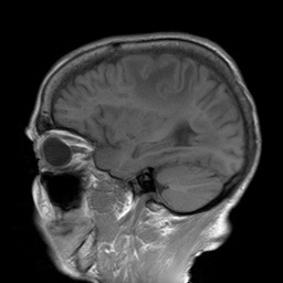 File:Cerebral amyloid angiopathy-related inflammation (Radiopaedia 74836-85849 Sagittal T1 12).jpg