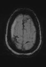 File:Cerebral amyloid angiopathy (Radiopaedia 29129-29518 Axial SWI MPR 32).jpg