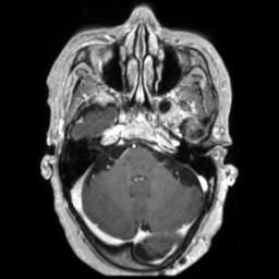 Cerebral amyloid angiopathy (Radiopaedia 29129-29518 Axial T1 C+ 40).jpg