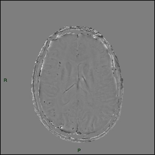 File:Cerebral amyloid angiopathy (Radiopaedia 77506-89664 H 61).jpg