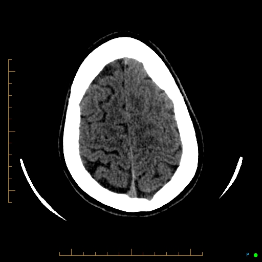 Cerebral arteriovenous malformation (AVM) (Radiopaedia 78162-90706 Axial non-contrast 54).jpg