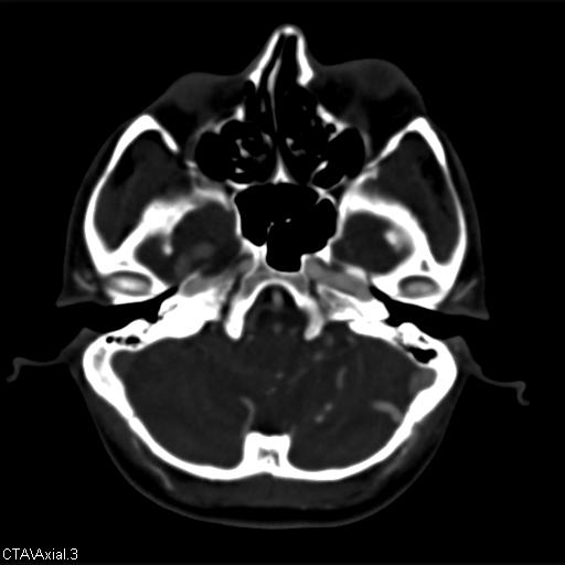 File:Cerebral arteriovenous malformation (Radiopaedia 28518-28759 B 3).jpg