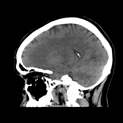 File:Cerebral arteriovenous malformation (Radiopaedia 39259-41505 B 23).png