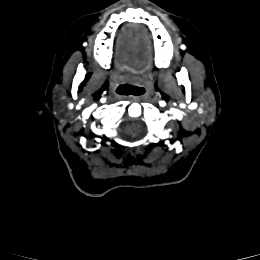 Cerebral arteriovenous malformation (Radiopaedia 73830-84645 Axial C+ delayed 94).jpg