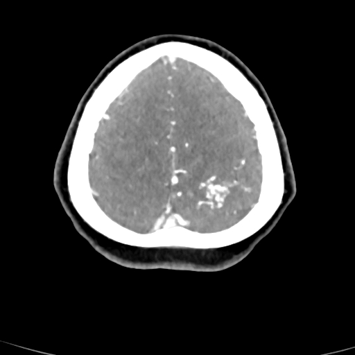 Cerebral arteriovenous malformation (Radiopaedia 73830-84645 B 16).jpg