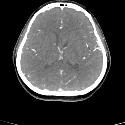 File:Cerebral arteriovenous malformation (Radiopaedia 73830-84645 B 46).jpg