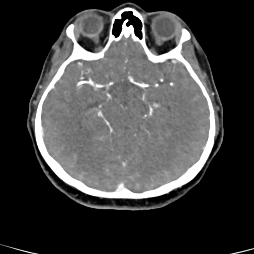 Cerebral arteriovenous malformation (Radiopaedia 73830-84645 B 59).jpg