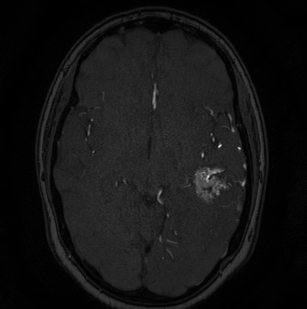 Cerebral arteriovenous malformation (Radiopaedia 74411-85654 Axial MRA 63).jpg