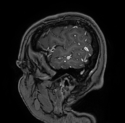 Cerebral arteriovenous malformation (Radiopaedia 74411-85654 Sagittal T1 C+ 11).jpg