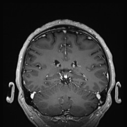 Cerebral arteriovenous malformation (Radiopaedia 84015-99245 Coronal T1 C+ 106).jpg