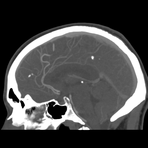Cerebral arteriovenous malformation (Spetzler-Martin grade 2) (Radiopaedia 41262-44076 G 28).png