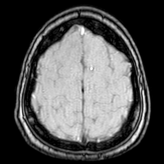 Cerebral arteriovenous malformation at posterior body of corpus callosum (Radiopaedia 74111-84925 Axial MRA 192).jpg