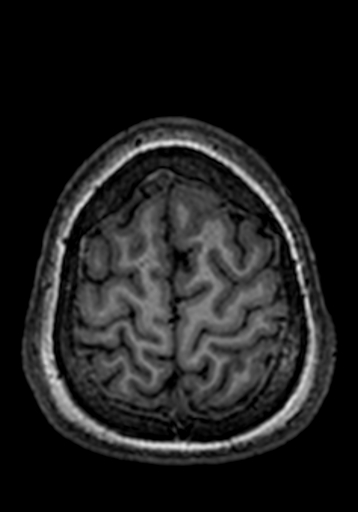 Cerebral arteriovenous malformation at posterior body of corpus callosum (Radiopaedia 74111-84925 Axial T1 25).jpg