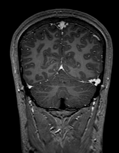 Cerebral arteriovenous malformation at posterior body of corpus callosum (Radiopaedia 74111-84925 K 293).jpg