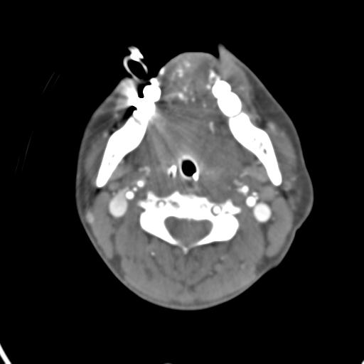 Cerebral arteriovenous malformation with hemorrhage (Radiopaedia 28773-29073 A 64).jpg
