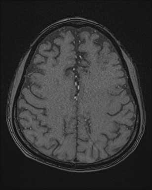 Cerebral embolic infarcts (embolic shower) (Radiopaedia 72391-82921 Axial MRA 147).jpg