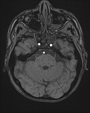 Cerebral embolic infarcts (embolic shower) (Radiopaedia 72391-82921 Axial MRA 35).jpg