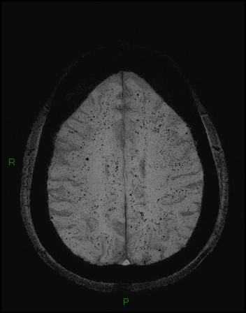 Cerebral fat embolism (Radiopaedia 35022-36525 Axial SWI 40).jpg