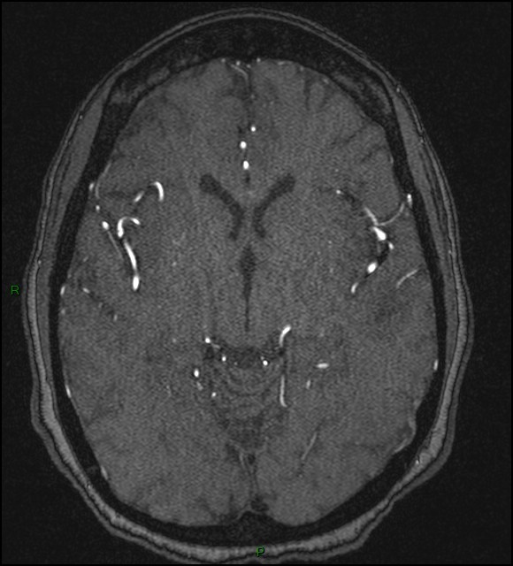 Cerebral fat embolism (Radiopaedia 35022-36525 Axial TOF 96).jpg