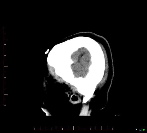 Cerebral fat embolism (Radiopaedia 85521-101220 B 6).jpg