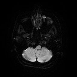 Cerebral metastases - melanoma (Radiopaedia 80972-94522 Axial DWI 7).jpg