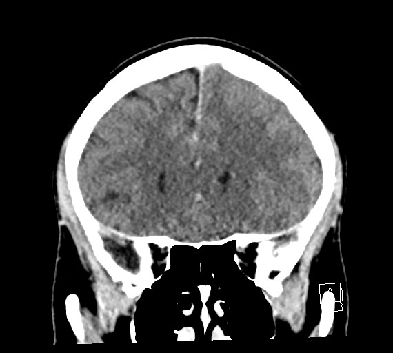 Cerebral metastases - testicular choriocarcinoma (Radiopaedia 84486-99855 D 20).jpg