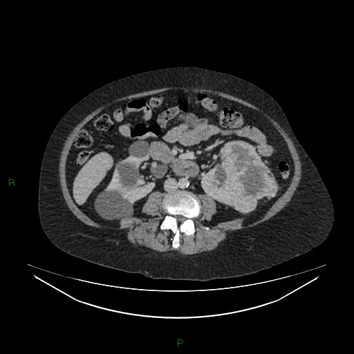 File:Cerebral metastasis from renal cell carcinoma (Radiopaedia 82306-96378 A 95).jpg