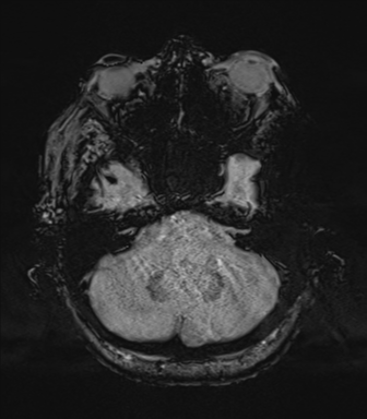 Cerebral metastasis to basal ganglia (Radiopaedia 81568-95413 Axial SWI 17).png