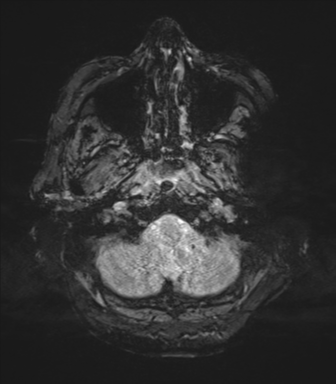 Cerebral metastasis to basal ganglia (Radiopaedia 81568-95413 Axial SWI magnitude 7).png