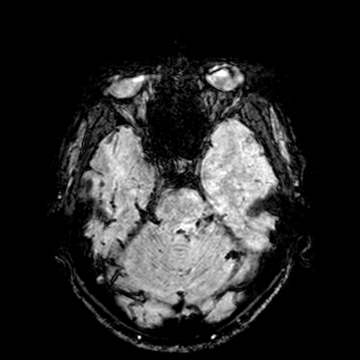 Cerebral parenchymal arteriovenous malformation (Radiopaedia 27280-27456 Axial SWI 29).jpg