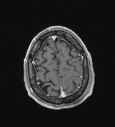 Cerebral toxoplasmosis (Radiopaedia 43956-47461 Axial T1 C+ 67).jpg