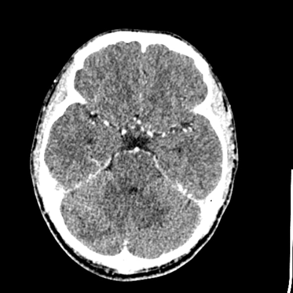 File:Cerebral toxoplasmosis (Radiopaedia 53993-60131 Axial C+ delayed 25).jpg