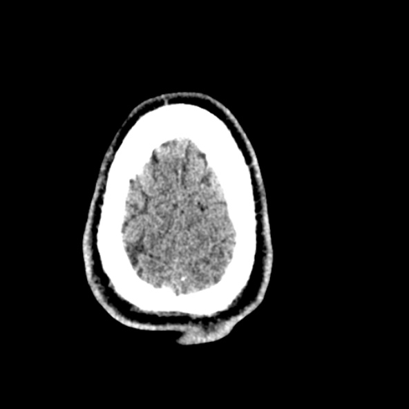 Cerebral toxoplasmosis (Radiopaedia 53993-60131 Axial non-contrast 71).jpg