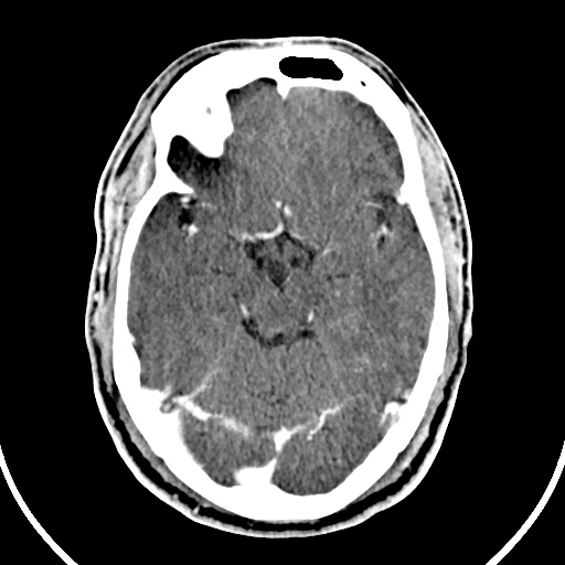 File:Cerebral venous angioma (Radiopaedia 69959-79977 B 29).jpg